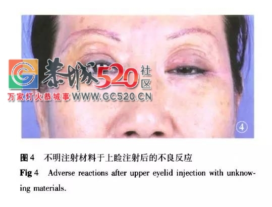 微整形还是“危整形”，不开刀的微整形安全吗？281 / 作者:疾控客服 / 帖子ID:235569
