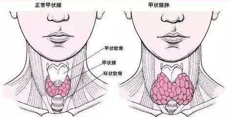 恭城县开展“防治碘缺乏病日”宣传活动，碘缺乏很可怕！这几类人群必须重视了！234 / 作者:看清所以看轻 / 帖子ID:261368