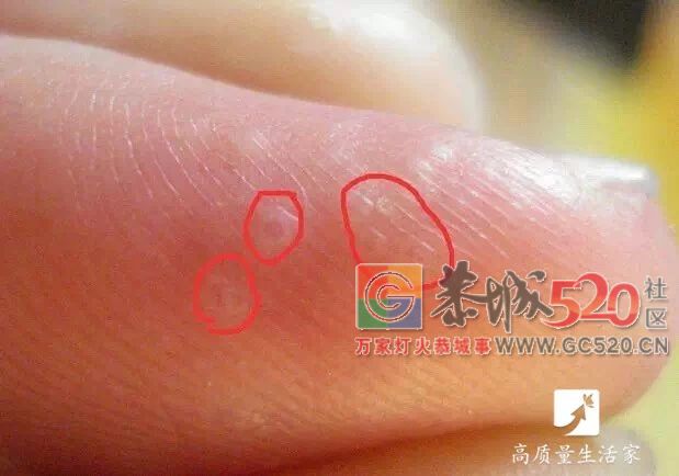 手上长小水疱千万别挑破，用它擦一擦，止痒防复发203 / 作者:和平街林广 / 帖子ID:261941