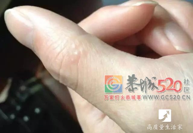 手上长小水疱千万别挑破，用它擦一擦，止痒防复发721 / 作者:和平街林广 / 帖子ID:261941