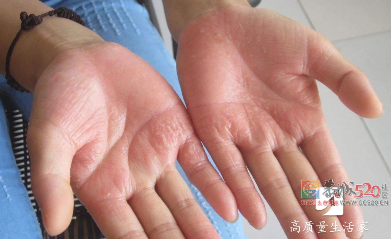 手上长小水疱千万别挑破，用它擦一擦，止痒防复发901 / 作者:和平街林广 / 帖子ID:261941