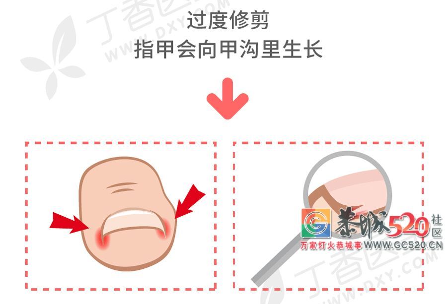 指甲剪不对，带来大麻烦！正确剪指甲应该这样做……306 / 作者:等风十里 / 帖子ID:261984