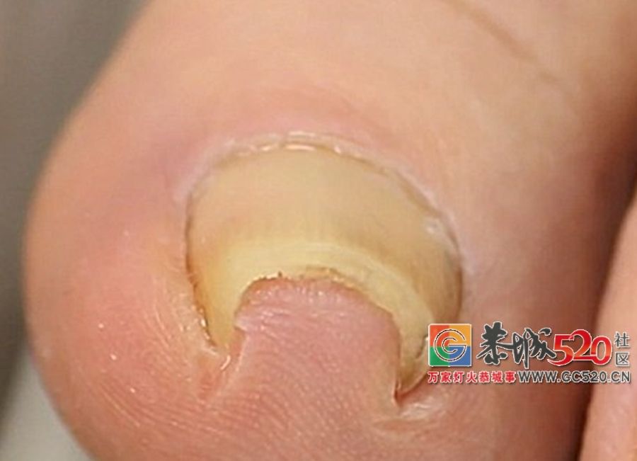 指甲剪不对，带来大麻烦！正确剪指甲应该这样做……545 / 作者:等风十里 / 帖子ID:261984