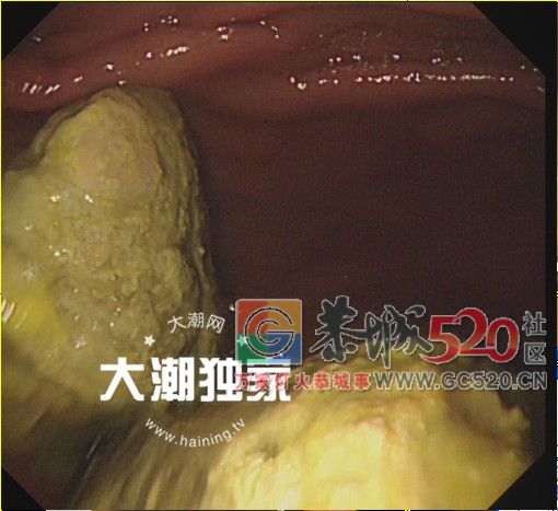 男子体内长了两大团……医生开方：喝可乐！喝一个星期！817 / 作者:对岸烽火 / 帖子ID:266321