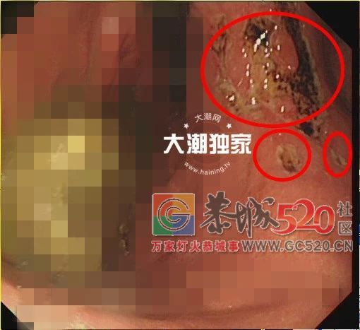 男子体内长了两大团……医生开方：喝可乐！喝一个星期！922 / 作者:对岸烽火 / 帖子ID:266321