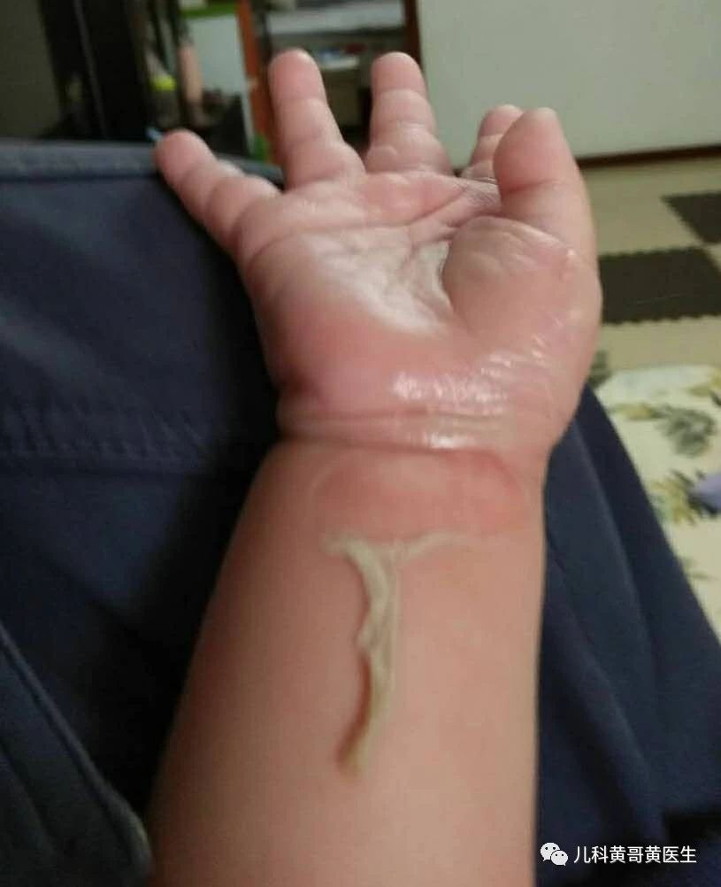 孩子烫伤后，因家长这个愚蠢做法进了ICU！再忙也要看！139 / 作者:雨云儿 / 帖子ID:273085