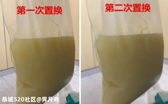 吃了顿烧烤，女子剧痛难忍，抽出几大袋牛奶血！千万别这样吃！322 / 作者:霁月吟 / 帖子ID:276944