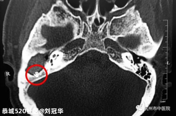 可怕！男子掏耳朵竟然掏出个……差点要命！医生紧急提醒848 / 作者:刘冠华 / 帖子ID:277157