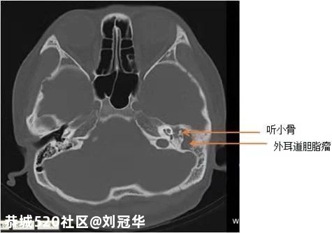 可怕！男子掏耳朵竟然掏出个……差点要命！医生紧急提醒502 / 作者:刘冠华 / 帖子ID:277157