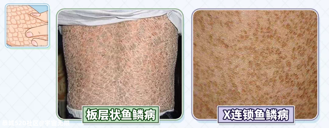 天气转凉，腿上的皮肤又开始干燥、脱皮？这就是“鱼鳞病”吗？158 / 作者:宇宙无限 / 帖子ID:277323