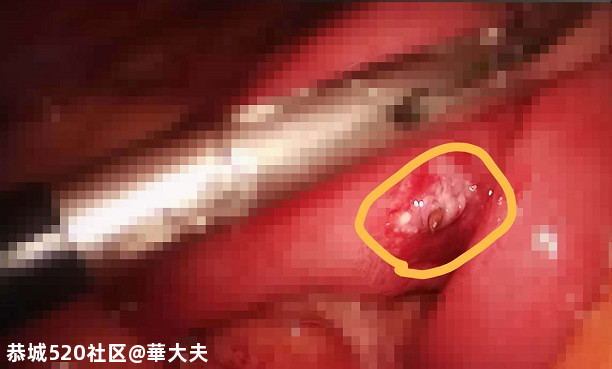 贵阳男子吃酒后回家腹痛，差点丟了命！罪魁祸首竟然是…每个人都要注意725 / 作者:華大夫 / 帖子ID:277789
