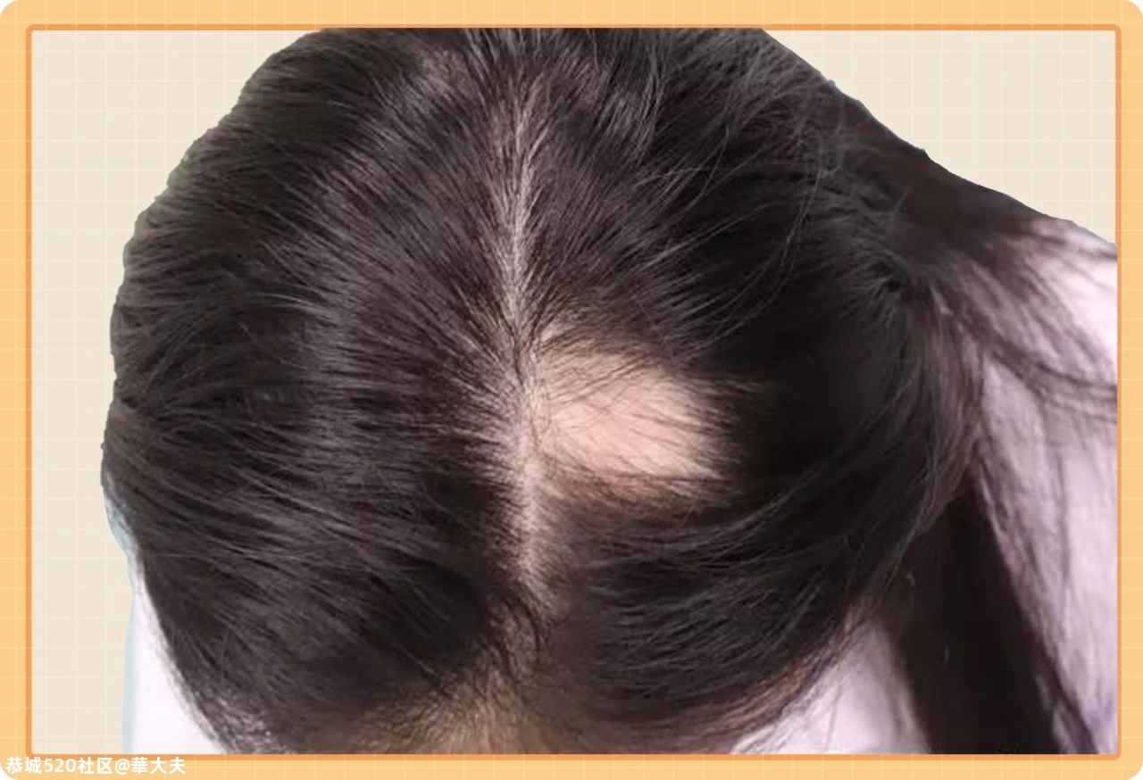 一觉睡醒，头发没了，听说是“鬼剃头”？别怕！这里有驱“鬼”妙招！608 / 作者:華大夫 / 帖子ID:277942