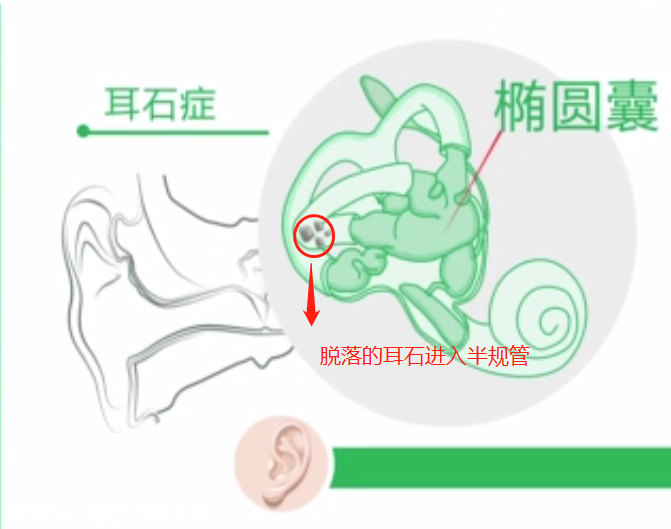 比耳屎还要可怕的耳石，是如何让你天旋地转的？704 / 作者:華大夫 / 帖子ID:277944