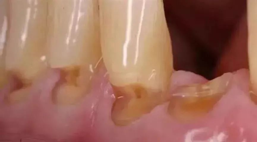 一个伤牙齿的刷牙习惯，让你越刷越糟糕882 / 作者:等风十里 / 帖子ID:278457