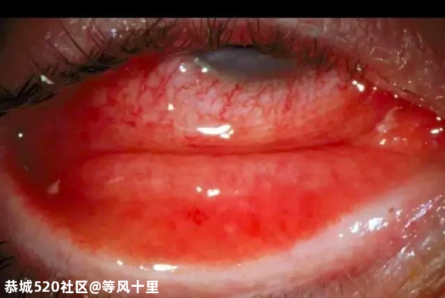 警惕！孩子打喷嚏、流鼻涕不一定是感冒，后果可能更严重909 / 作者:等风十里 / 帖子ID:278600