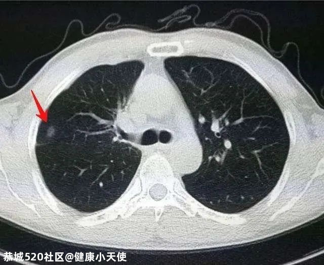 体检发现肺结节，我是不是要死了？259 / 作者:健康小天使 / 帖子ID:279500