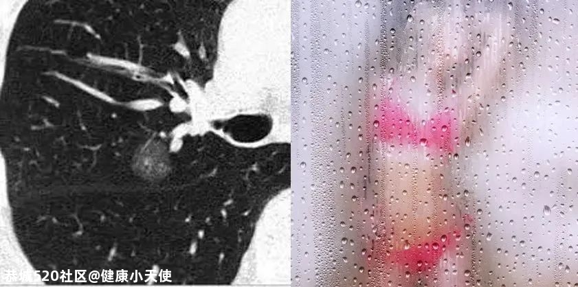 体检发现肺结节，我是不是要死了？230 / 作者:健康小天使 / 帖子ID:279500