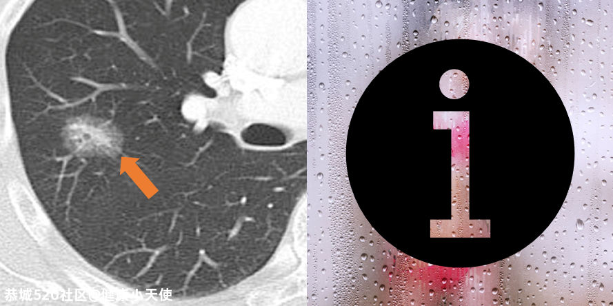 体检发现肺结节，我是不是要死了？602 / 作者:健康小天使 / 帖子ID:279500