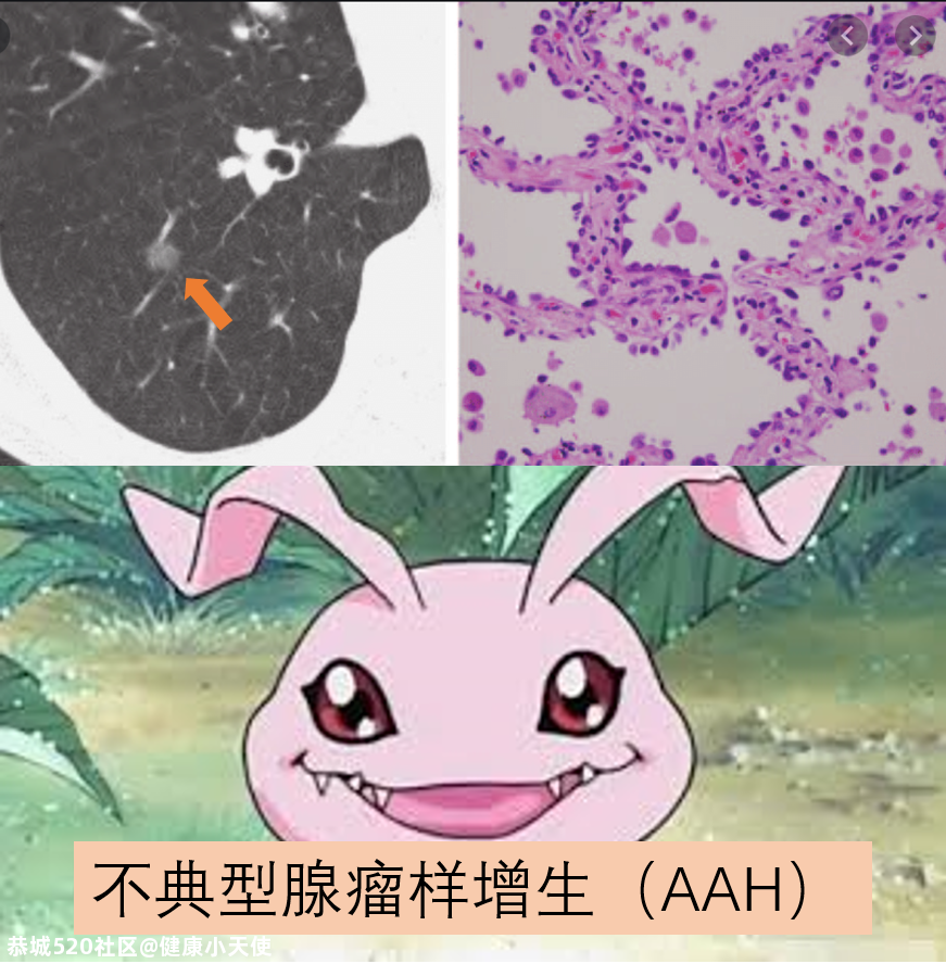 体检发现肺结节，我是不是要死了？646 / 作者:健康小天使 / 帖子ID:279500
