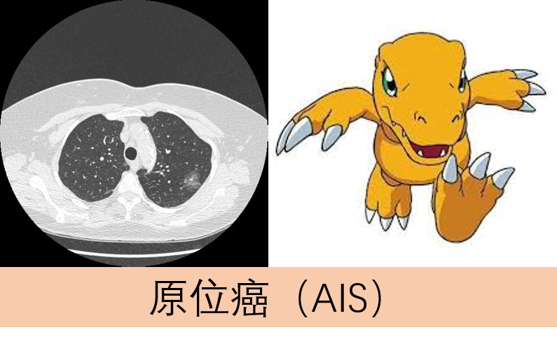 体检发现肺结节，我是不是要死了？918 / 作者:健康小天使 / 帖子ID:279500