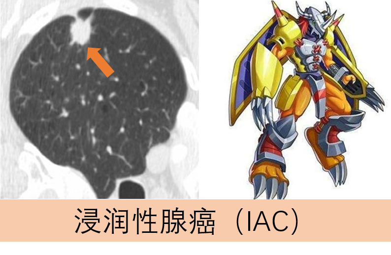 体检发现肺结节，我是不是要死了？267 / 作者:健康小天使 / 帖子ID:279500