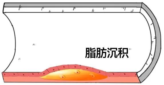 为什么说每个人的血管都可能会堵？611 / 作者:健康小天使 / 帖子ID:279623