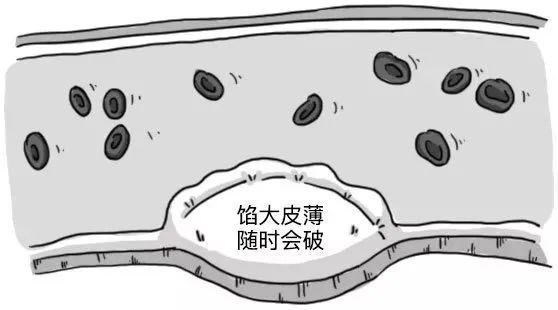 为什么说每个人的血管都可能会堵？958 / 作者:健康小天使 / 帖子ID:279623