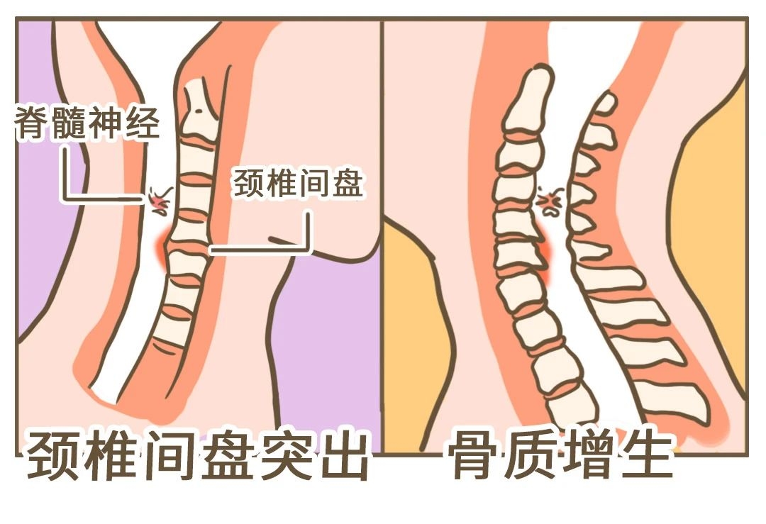 落枕可能是身体的「求救信号」，别不当回事！131 / 作者:健康小天使 / 帖子ID:279977