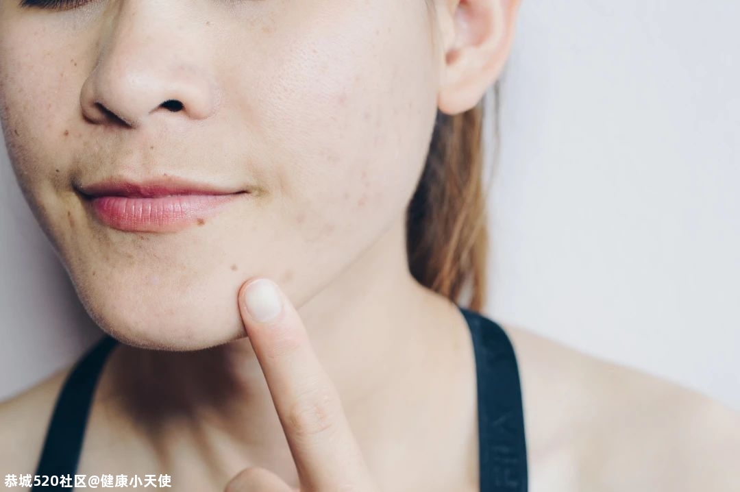 下巴反复长痘，是生殖系统出问题了？77 / 作者:健康小天使 / 帖子ID:280881