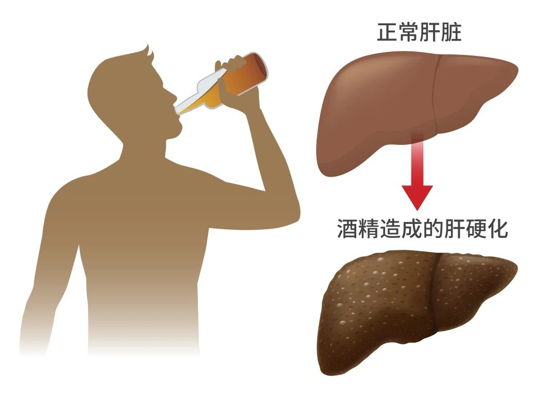 喝酒伤身，怎么减少危害？盘点 9 种解酒方法，有效的只有 1 个139 / 作者:健康小天使 / 帖子ID:280939
