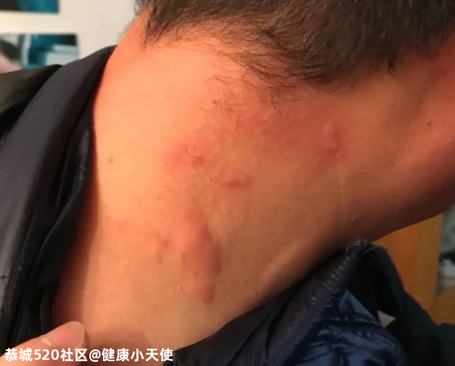 奇！大小伙子居然对冷空气“过敏”了！这些冬季易发病，快小心！304 / 作者:健康小天使 / 帖子ID:281120