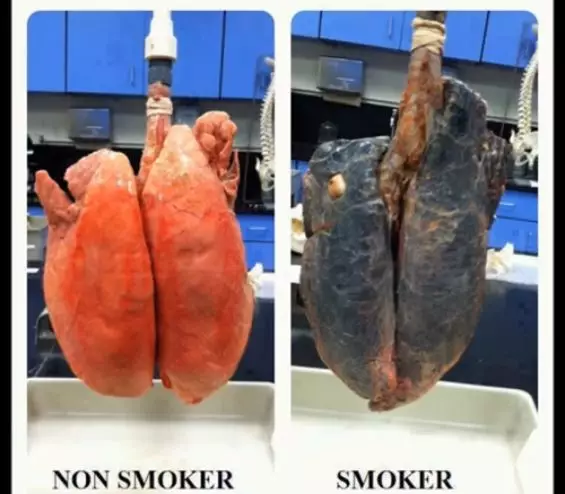 3 包烟就能熏黑一个肺！看过这组实验，你一定能戒烟560 / 作者:健康小天使 / 帖子ID:281144