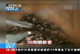 3 包烟就能熏黑一个肺！看过这组实验，你一定能戒烟206 / 作者:健康小天使 / 帖子ID:281144