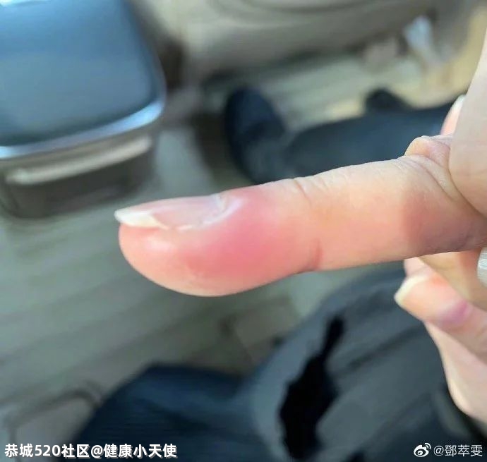 知名女演员拔倒刺做手术上了热搜！医生紧急提醒450 / 作者:健康小天使 / 帖子ID:283631