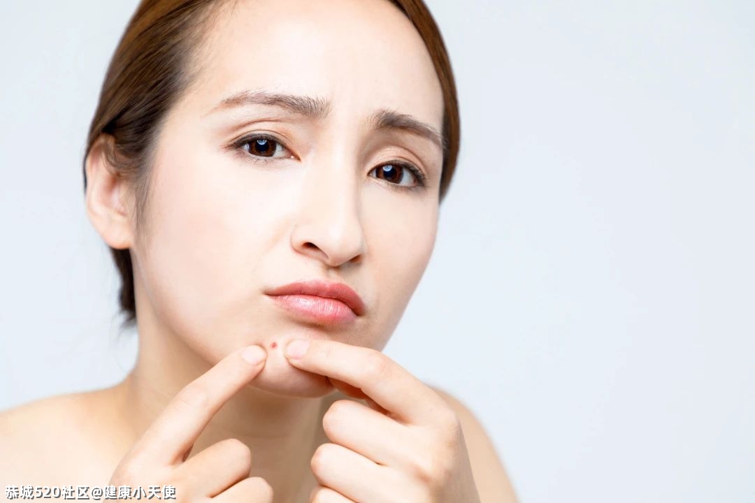 长痘到底要不要忌口？45 / 作者:健康小天使 / 帖子ID:283689