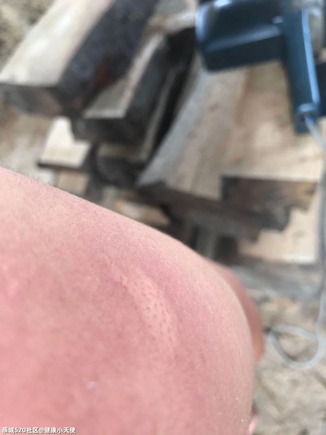 提醒！恭城人清明扫墓看到这种土堆，赶紧躲开，不少人已中招！466 / 作者:健康小天使 / 帖子ID:283902