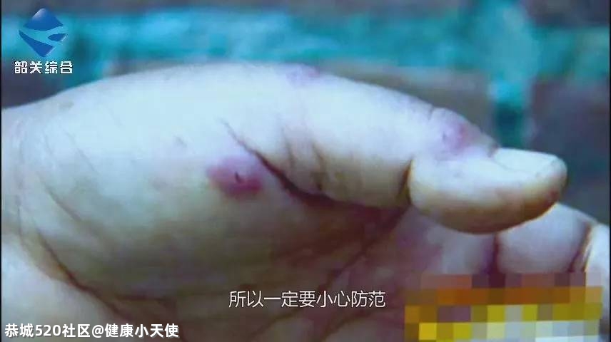 提醒！恭城人清明扫墓看到这种土堆，赶紧躲开，不少人已中招！6 / 作者:健康小天使 / 帖子ID:283902