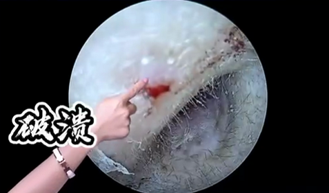 看看！耳窥镜下，被你“掏”的耳朵受伤有多深？898 / 作者:健康小天使 / 帖子ID:283903