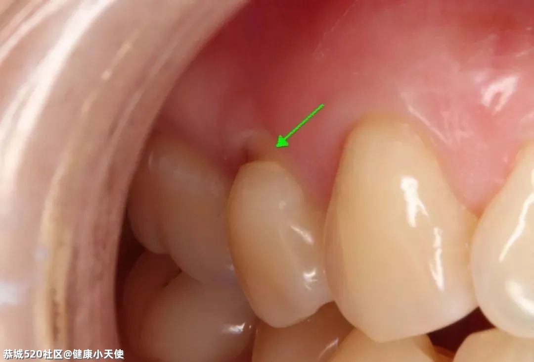 没蛀牙，为什么牙齿也会酸痛？54 / 作者:健康小天使 / 帖子ID:284006