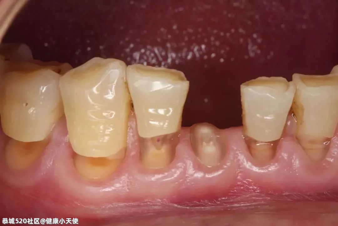没蛀牙，为什么牙齿也会酸痛？7 / 作者:健康小天使 / 帖子ID:284006