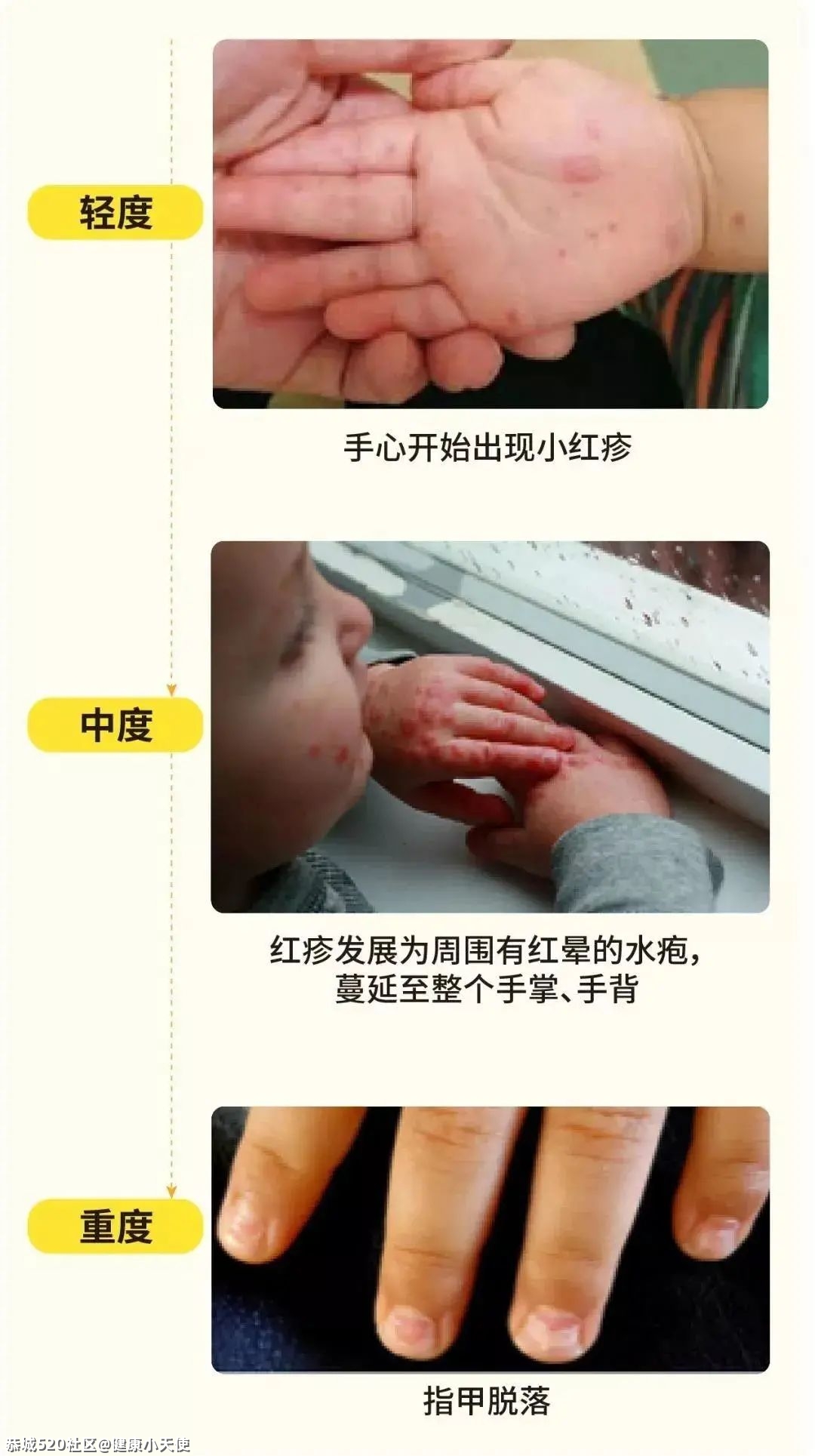 恭城家长注意！这种传染病已经进入高发期，尚无特效药892 / 作者:健康小天使 / 帖子ID:284444