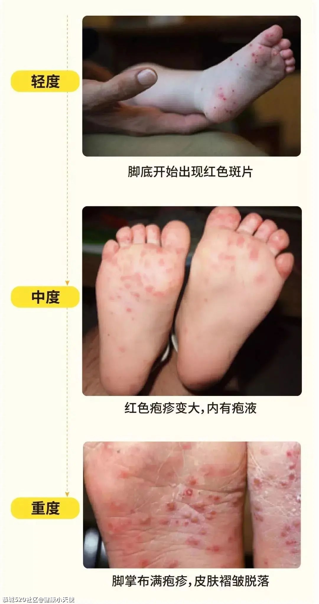 恭城家长注意！这种传染病已经进入高发期，尚无特效药591 / 作者:健康小天使 / 帖子ID:284444