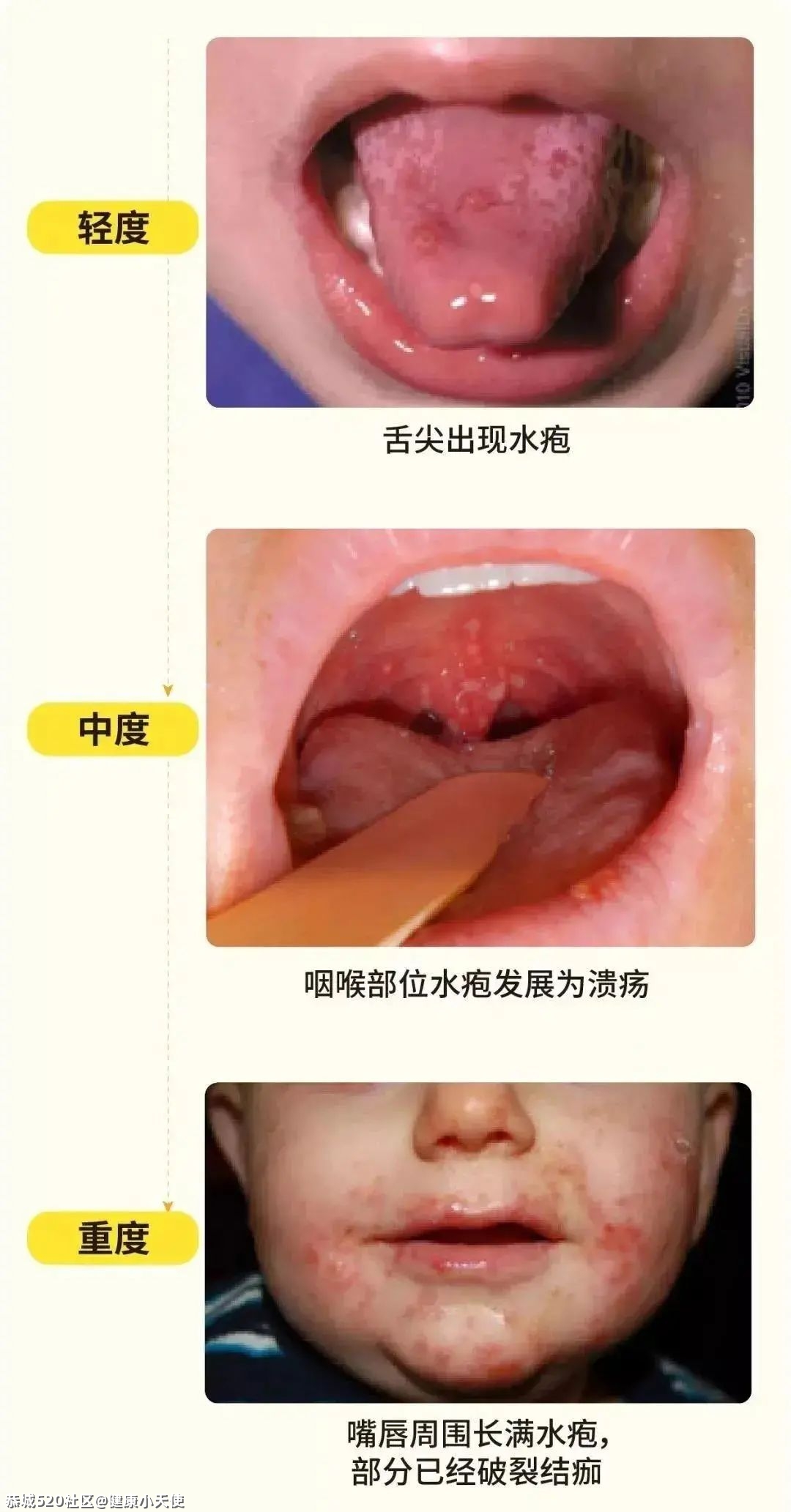 恭城家长注意！这种传染病已经进入高发期，尚无特效药210 / 作者:健康小天使 / 帖子ID:284444