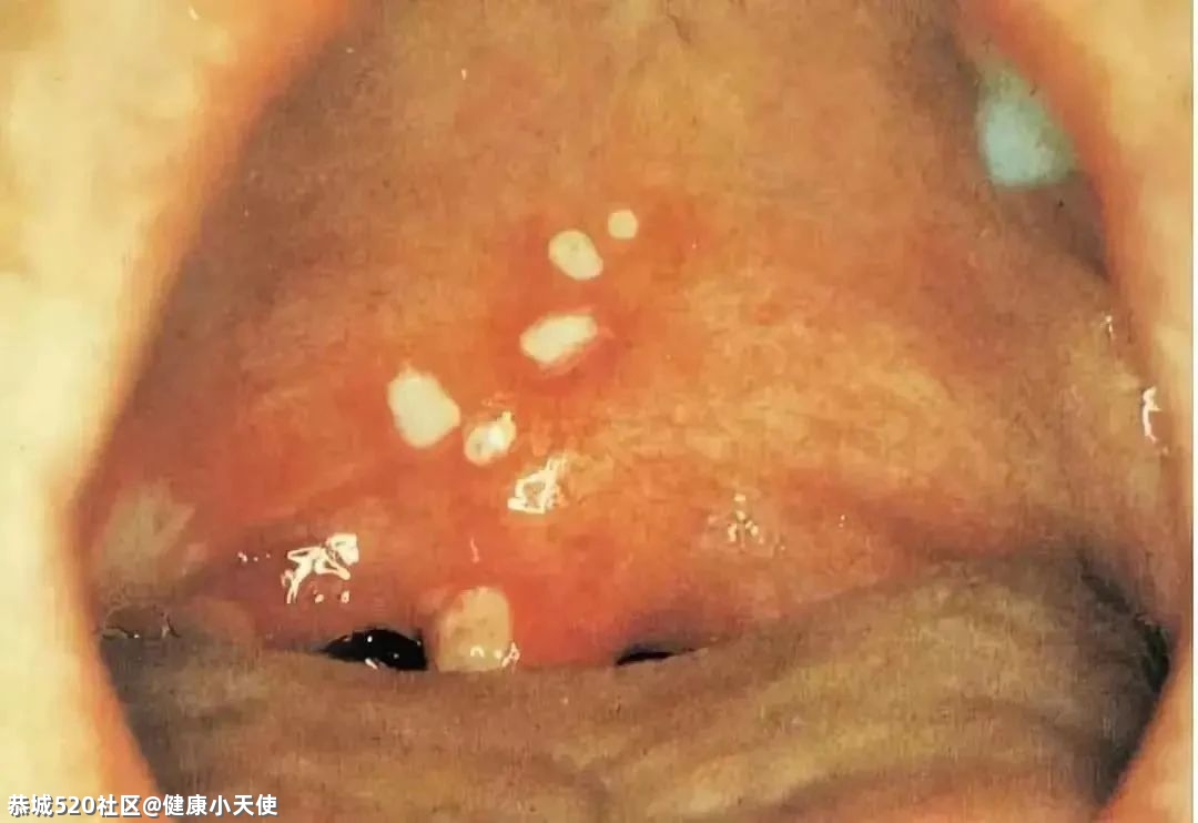恭城家长注意！近期高发！和手足口很像，一感染就要回家隔离！531 / 作者:健康小天使 / 帖子ID:284884