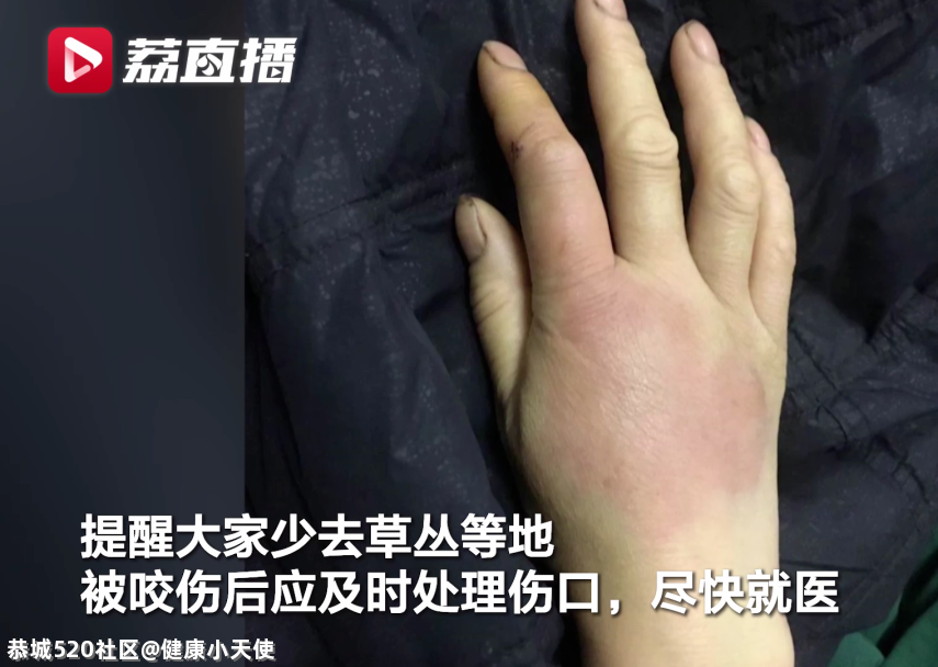被这种虫子咬一口，女子窒息身亡！被咬后千万别这样做257 / 作者:健康小天使 / 帖子ID:284923