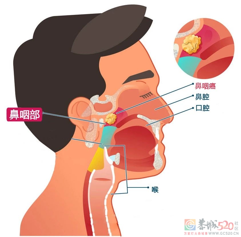 有一种癌偏爱「南方人」，这个省的发病数占了全国的60%748 / 作者:健康小天使 / 帖子ID:287549