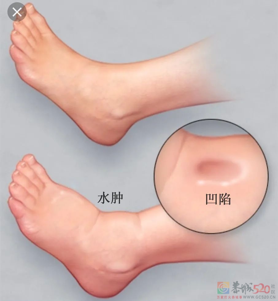 不同部位的「肿」暗示了什么？一组“水肿位置图”搞清楚665 / 作者:健康小天使 / 帖子ID:290393