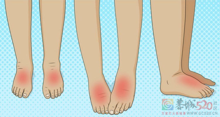 不同部位的「肿」暗示了什么？一组“水肿位置图”搞清楚855 / 作者:健康小天使 / 帖子ID:290393