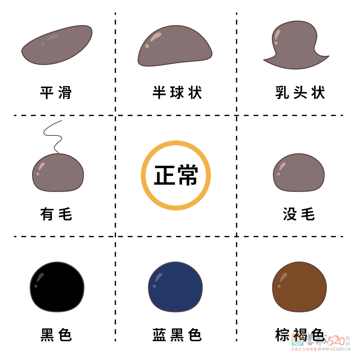 痣也可能会癌变！长在 3 个地方要注意669 / 作者:健康小天使 / 帖子ID:292802