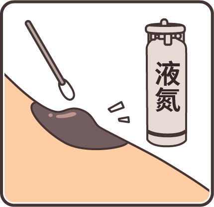 痣也可能会癌变！长在 3 个地方要注意392 / 作者:健康小天使 / 帖子ID:292802
